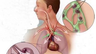 Bệnh Viêm phổi do nấm: Nguyên nhân, biến chứng và cách điều trị